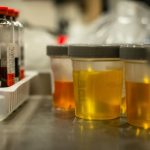 a-selection-of-urine-samples-ready-for-urinalysis